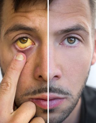 Guide-Alimentation-MaladiesYeux-Ictere